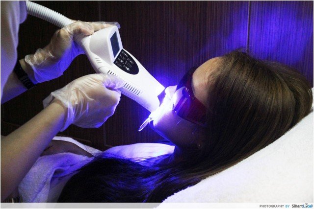 blanqueamiento dental led laser blanqueamiento dental led laser